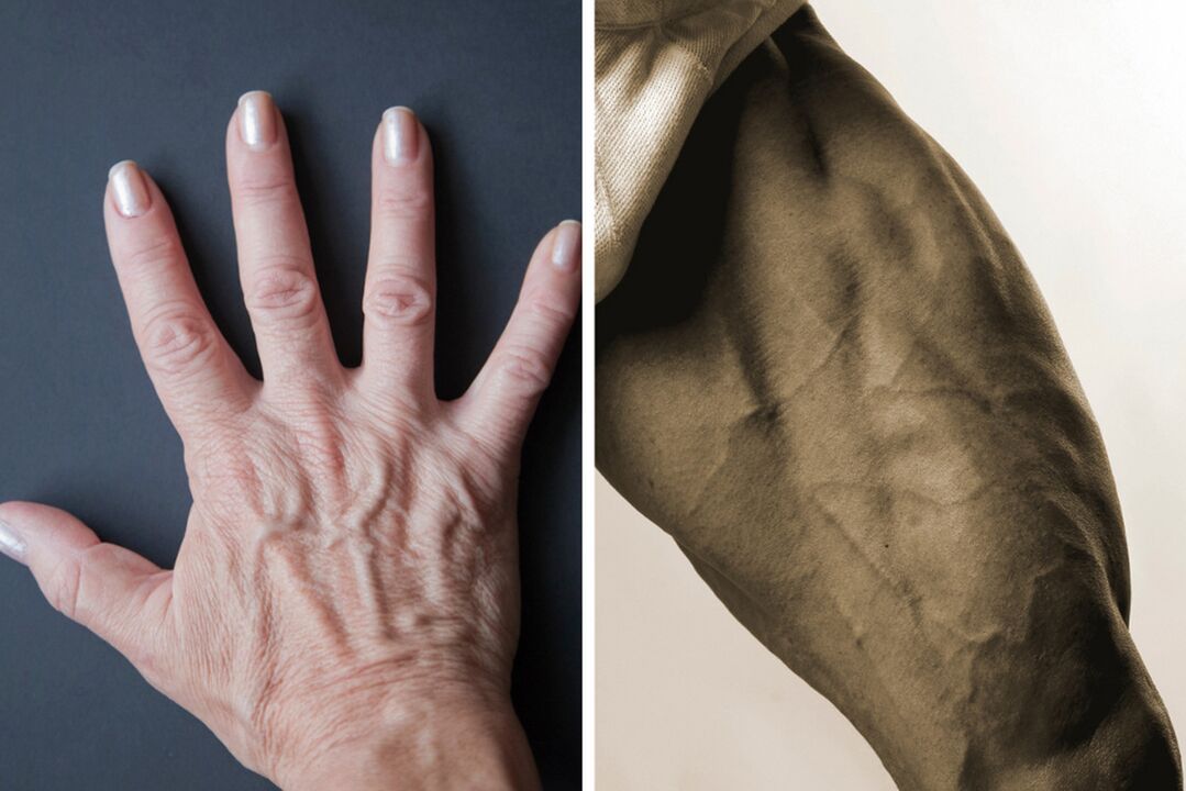 Síntomas de las venas varicosas