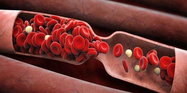 Prevención de coágulos de sangre