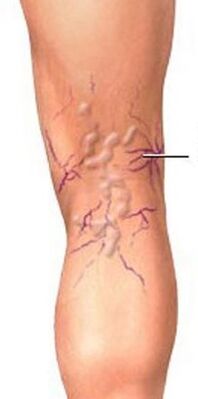 Varices