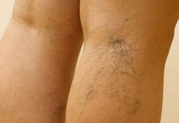varices