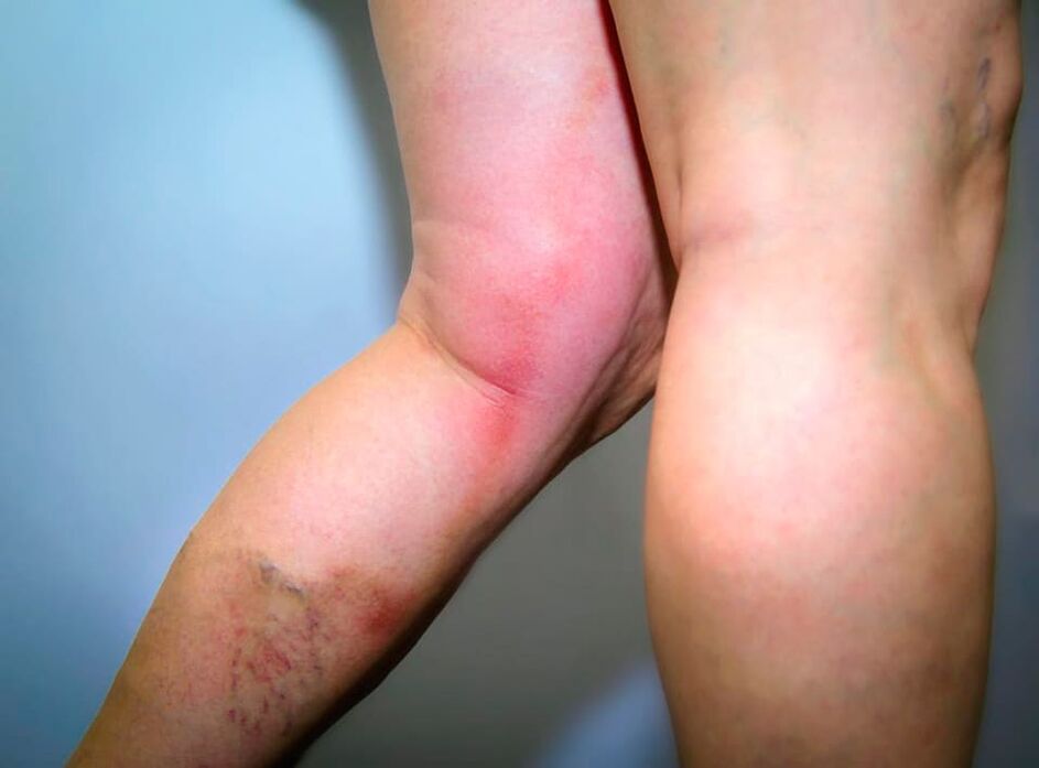Las consecuencias de las venas varicosas