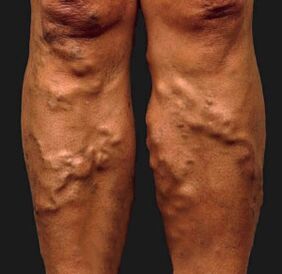 Varices