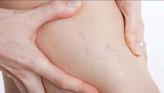 Las arañas vasculares en las piernas son un signo de venas varicosas