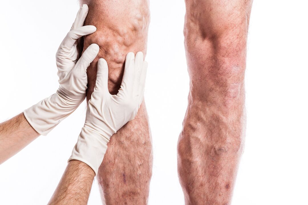 El flebólogo examina las piernas de un paciente con venas varicosas