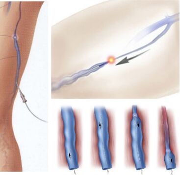 método de tratamiento de las venas varicosas coagulación con láser endovenoso