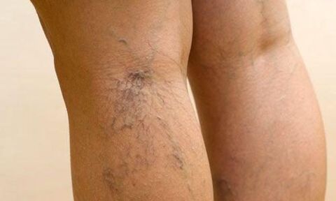 venas varicosas en las piernas