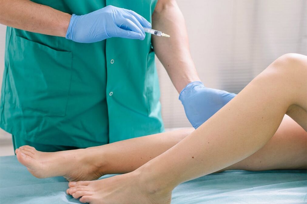 escleroterapia para la eliminación de venas varicosas