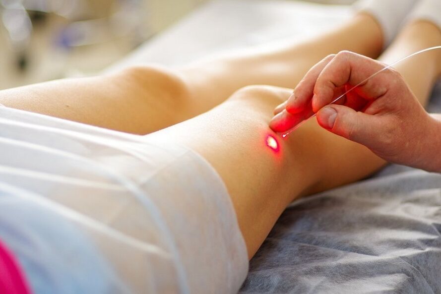 tratamiento con láser para venas varicosas