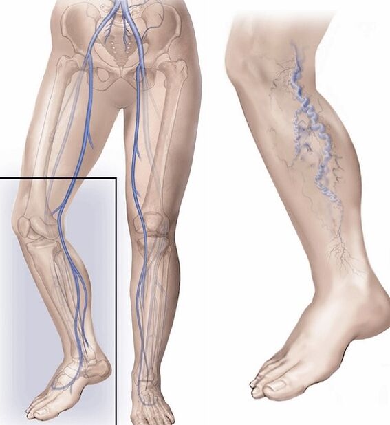 Venas sanas y venas afectadas por venas varicosas.