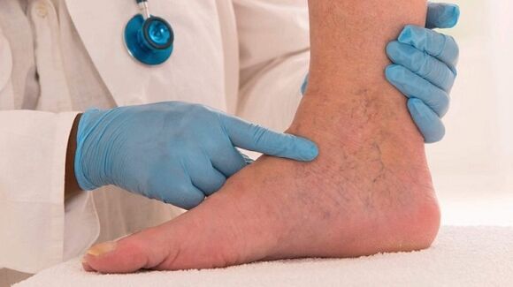 médico examinando piernas con venas varicosas