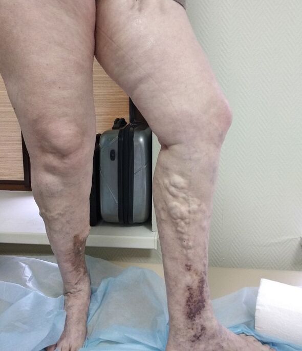 piernas con venas varicosas
