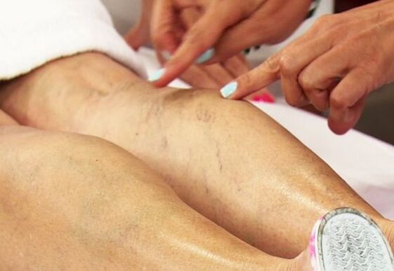 examen de las piernas con venas varicosas en mujeres