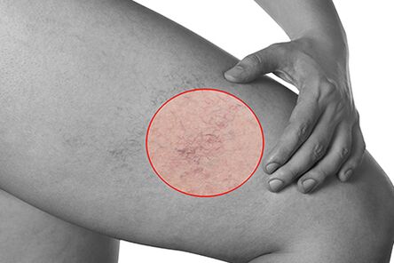 Telangiectasia en venas varicosas de las extremidades inferiores