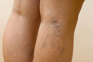 foto de venas varicosas en las piernas