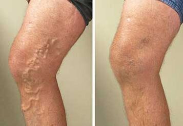 Varicosis que es